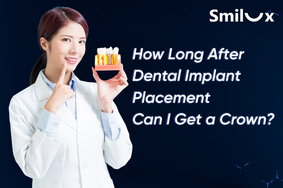 How Long After Dental Implant Placement Can I Get a Crown? How Long After Dental Implant Placement Can I Get a Crown?