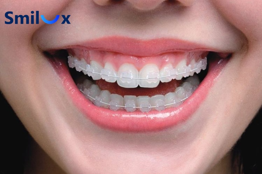 Ai phù hợp với niềng răng mắc cài sứ? Ai phù hợp với niềng răng mắc cài sứ?