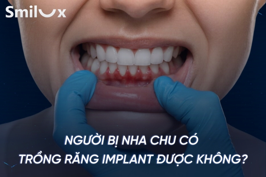 Người bị nha chu có trồng răng Implant được không? Người bị nha chu có trồng răng Implant được không?
