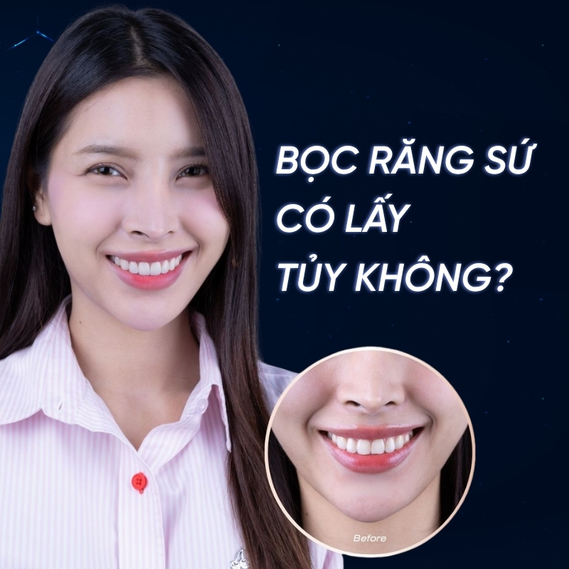 bọc răng sứ có lấy tủy không smilux dental