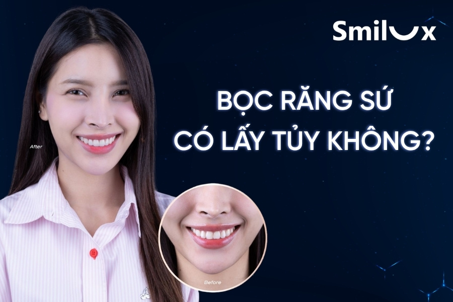 Bọc răng sứ có lấy tủy không? Tư vấn từ bác sĩ Smilux Dental Bọc răng sứ có lấy tủy không? Tư vấn từ bác sĩ Smilux Dental