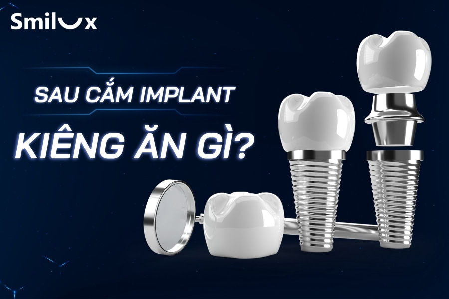 Cắm Implant kiêng ăn gì? TOP 5 thực phẩm kiêng cữ sau cắm Implant Cắm Implant kiêng ăn gì? TOP 5 thực phẩm kiêng cữ sau cắm Implant