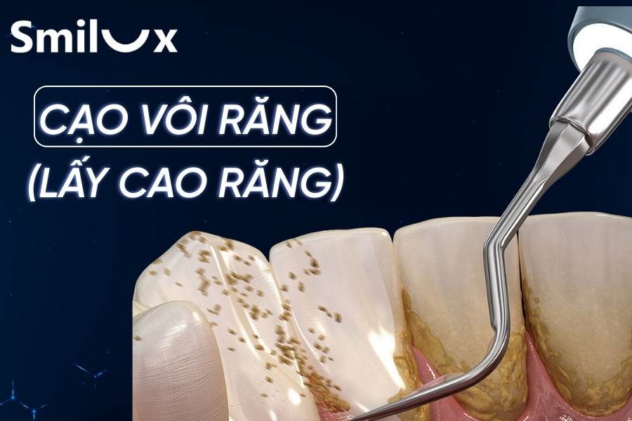 Có nên cạo vôi răng không? Lấy cao răng bao nhiêu tiền? Có nên cạo vôi răng không? Lấy cao răng bao nhiêu tiền?