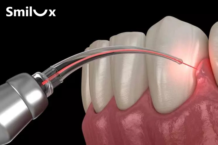 Cắt nướu tạo hình bằng laser Cắt nướu tạo hình bằng laser