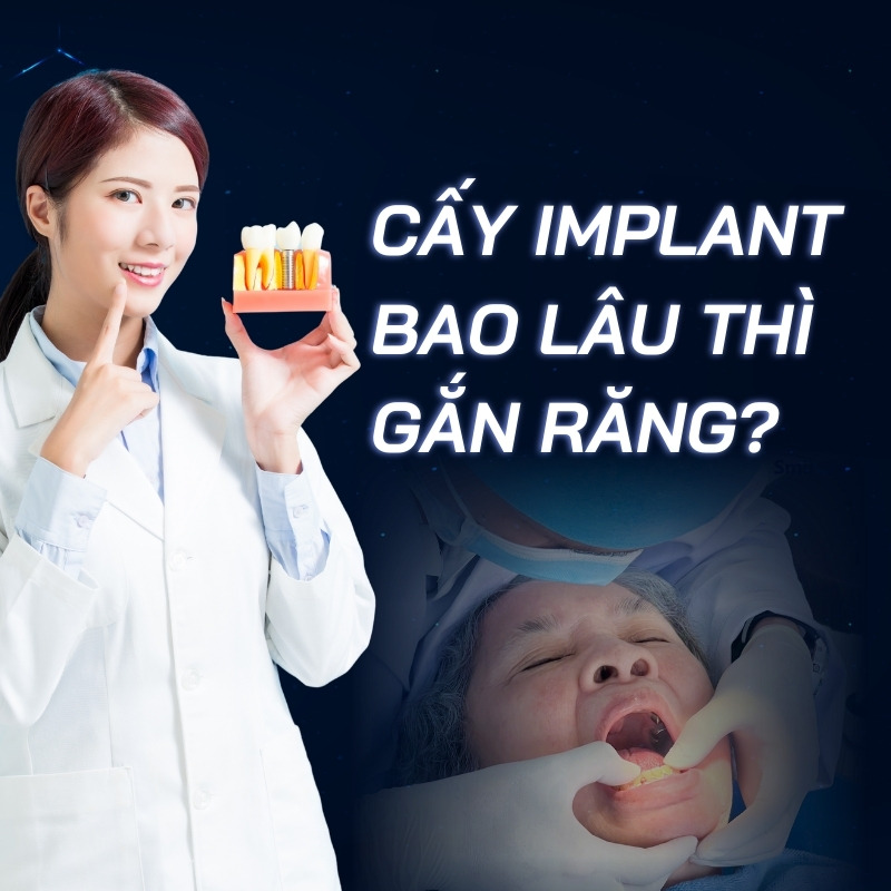 cấy Implant bao lâu thì gắn răng smilux