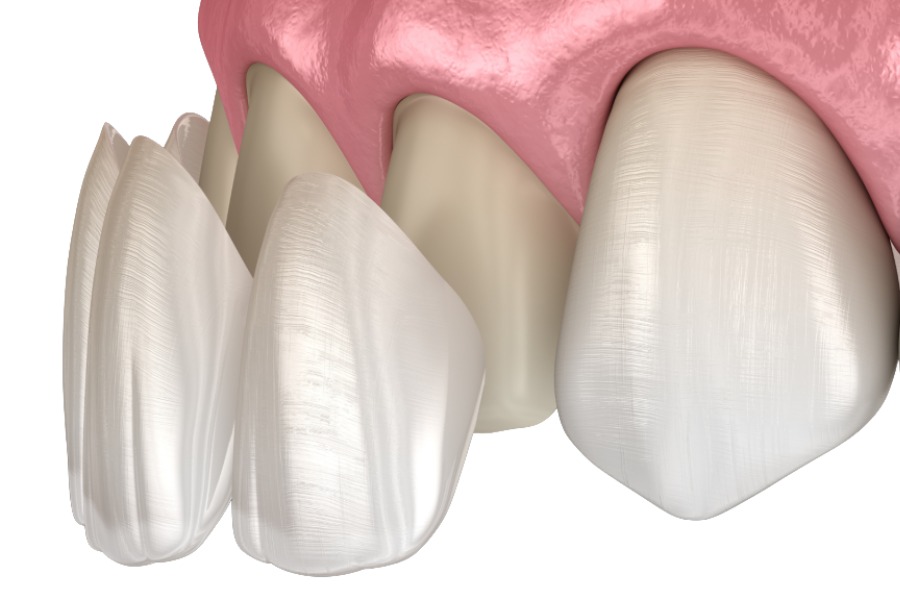 dan rang su veneer