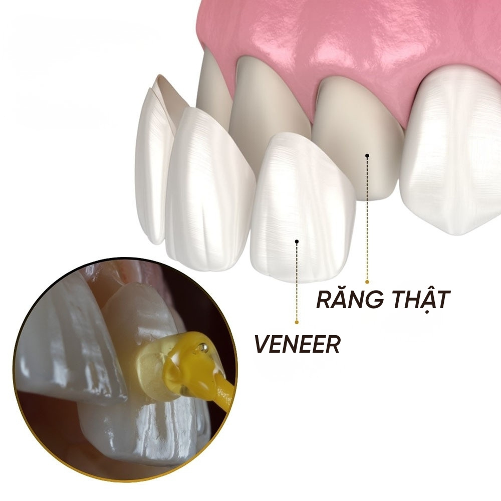 dán răng veneer là gì