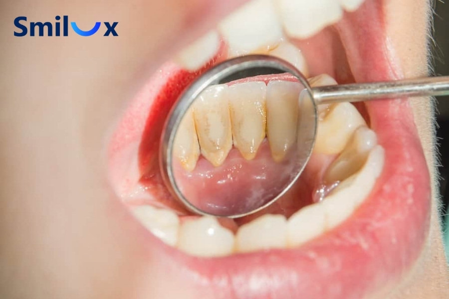 Định kỳ cạo vôi răng giúp làm sạch mảng bám cứng đầu trên bề mặt răng và dưới nướu Định kỳ cạo vôi răng giúp làm sạch mảng bám cứng đầu trên bề mặt răng và dưới nướu