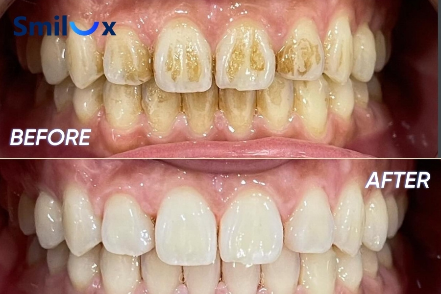 Đối tượng chỉ định cạo vôi răng Đối tượng chỉ định cạo vôi răng