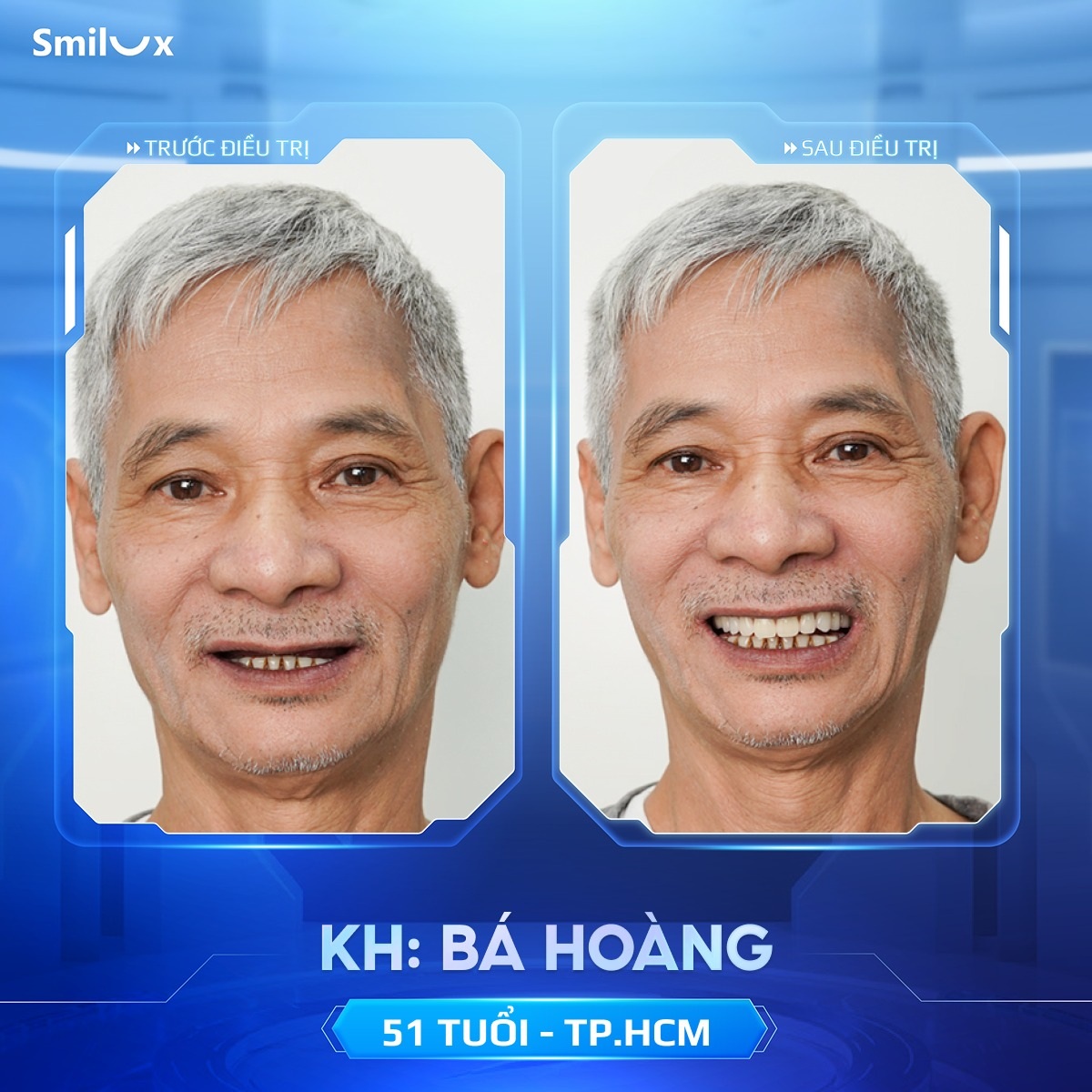 khách hàng implant 1
