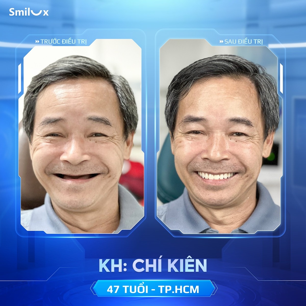 khách hàng implant 3