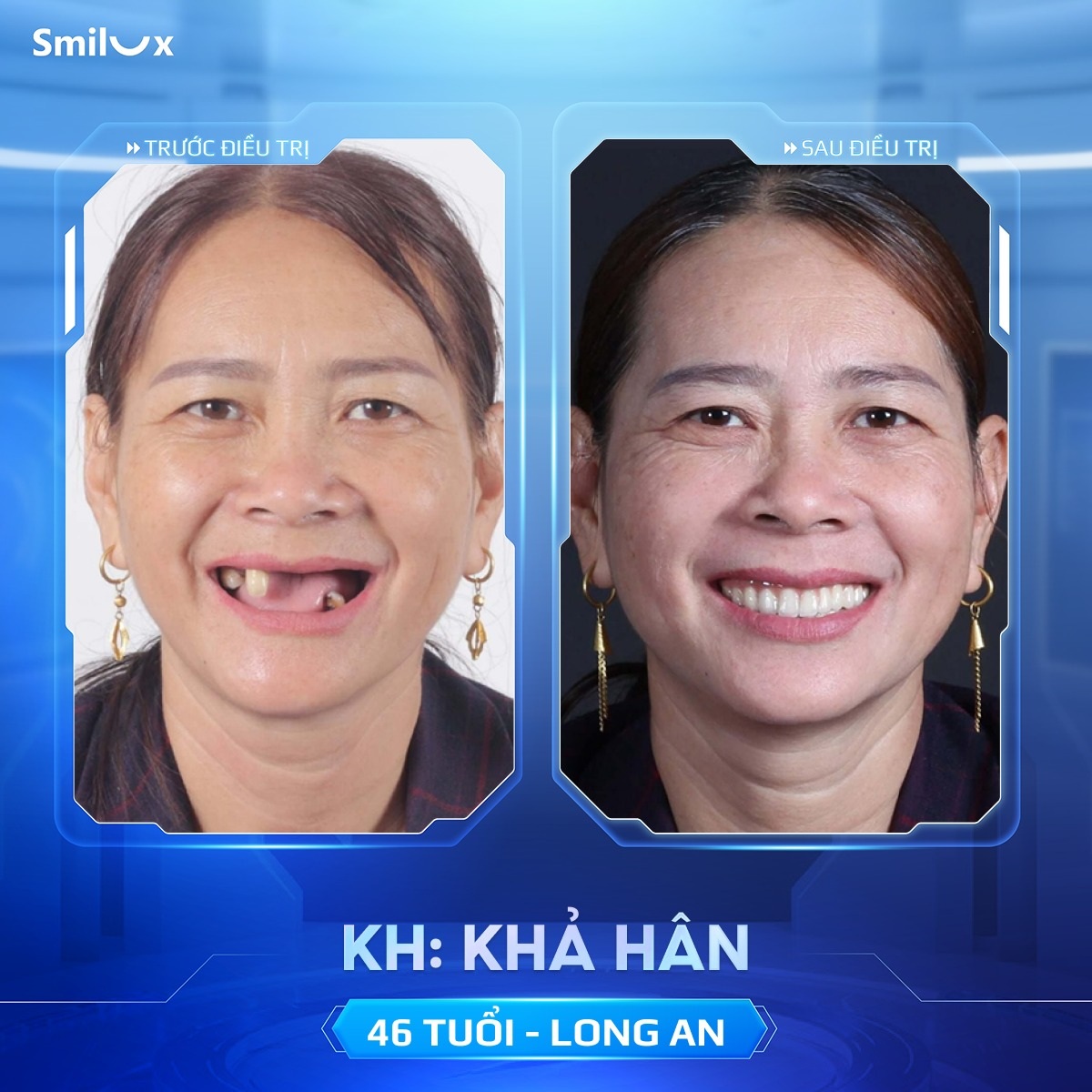 khách hàng implant 5