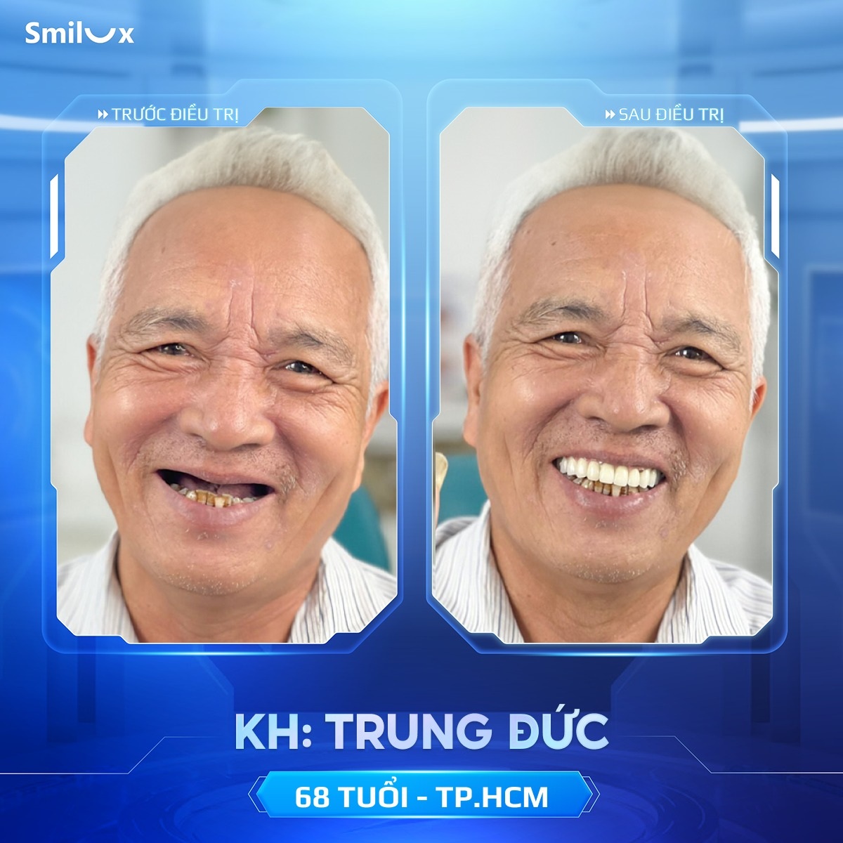 khách hàng implant 6