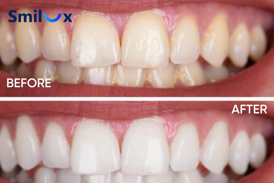 Khi nào nên tẩy trắng răng Khi nào nên tẩy trắng răng