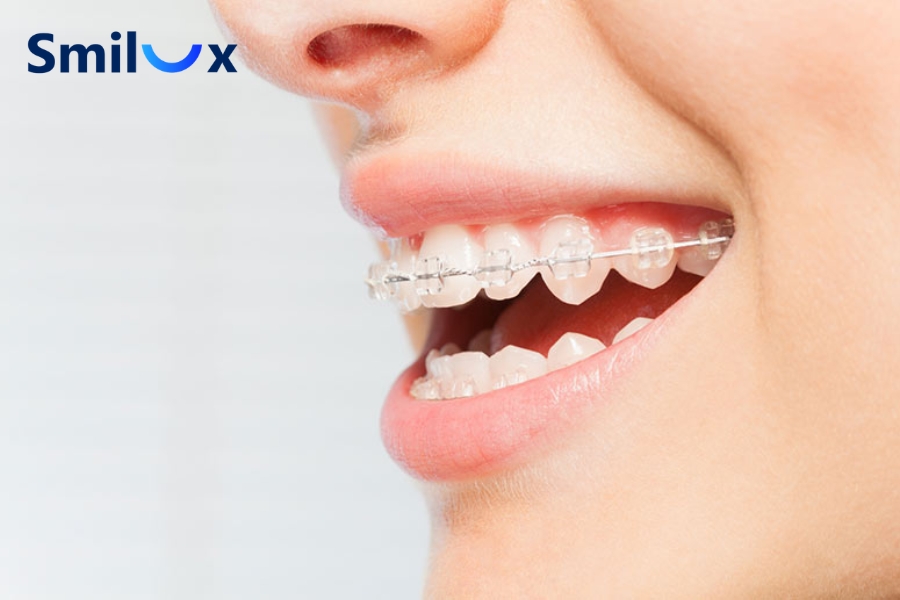 Niềng răng mắc cài pha lê an toàn và ít gây kích ứng trong khoang miệng Niềng răng mắc cài pha lê an toàn và ít gây kích ứng trong khoang miệng