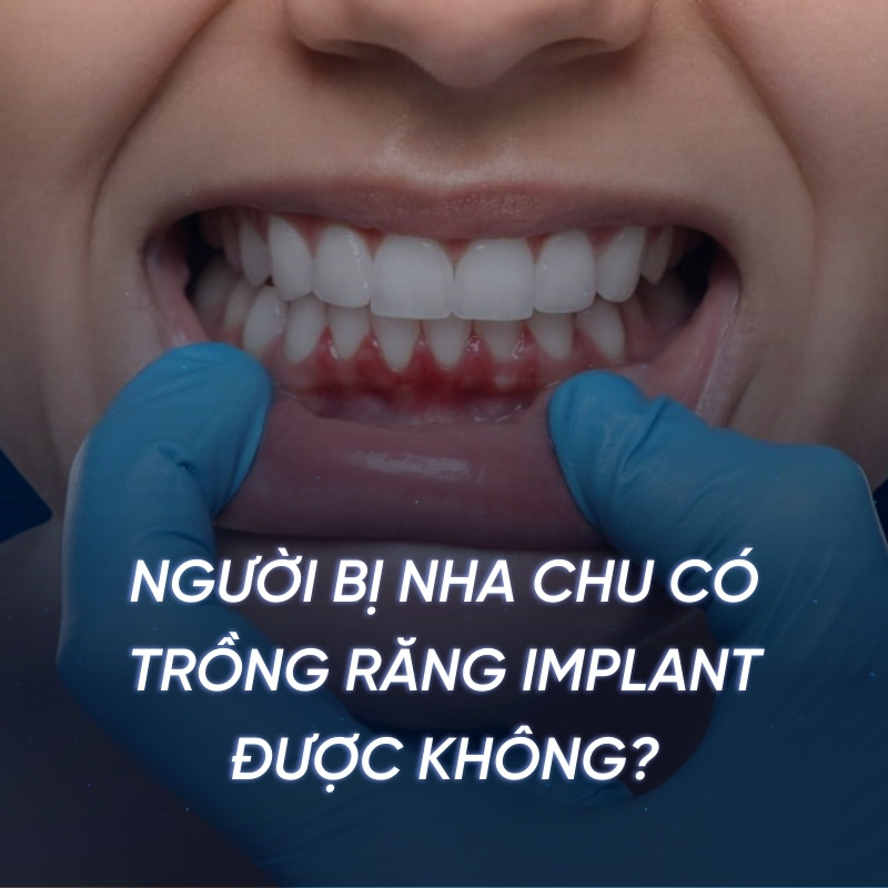 Người bị nha chu có trồng răng Implant được không?