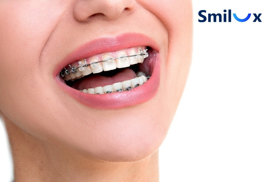 Nhổ răng để chỉnh nha Nhổ răng để chỉnh nha