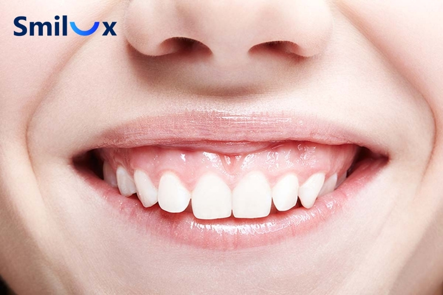 Người bị cười hở lợi do nướu phát triển quá mức thường là đối tượng phù hợp để thực hiện cắt nướu Người bị cười hở lợi do nướu phát triển quá mức thường là đối tượng phù hợp để thực hiện cắt nướu