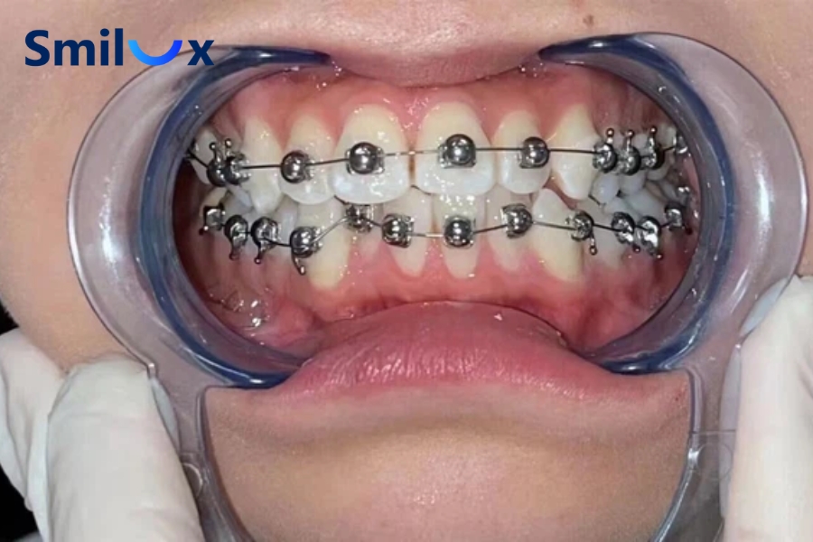 Những ai phù hợp niềng răng mắc cài cánh cam? Những ai phù hợp niềng răng mắc cài cánh cam?