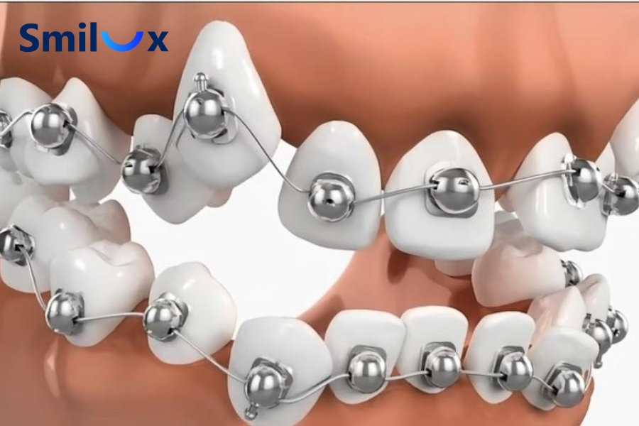 Niềng răng mắc cài cánh cam là gì? Niềng răng mắc cài cánh cam là gì?