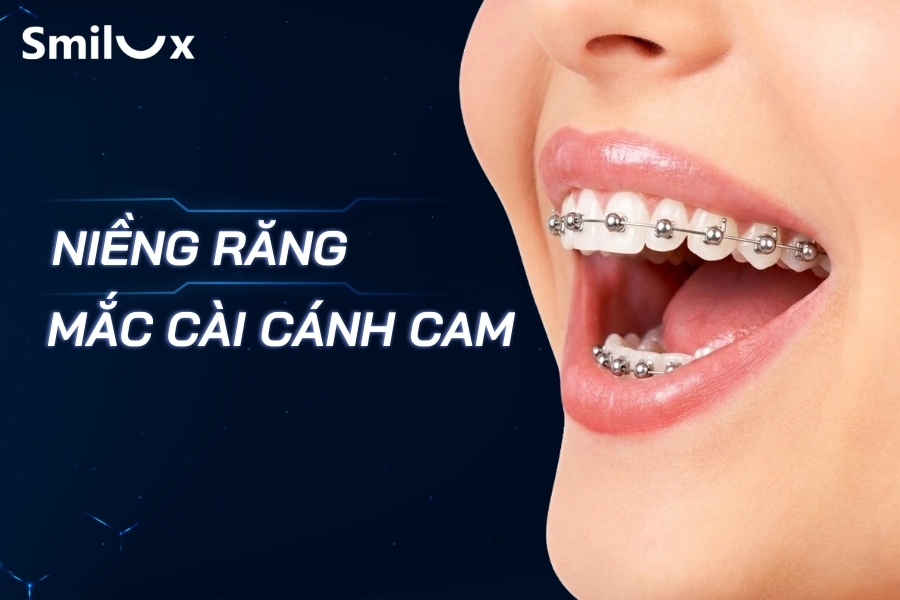 Niềng Răng Mắc Cài Cánh Cam - Giải Pháp Chỉnh Nha Hiện Đại, Thẩm Mỹ Cao Niềng Răng Mắc Cài Cánh Cam - Giải Pháp Chỉnh Nha Hiện Đại, Thẩm Mỹ Cao