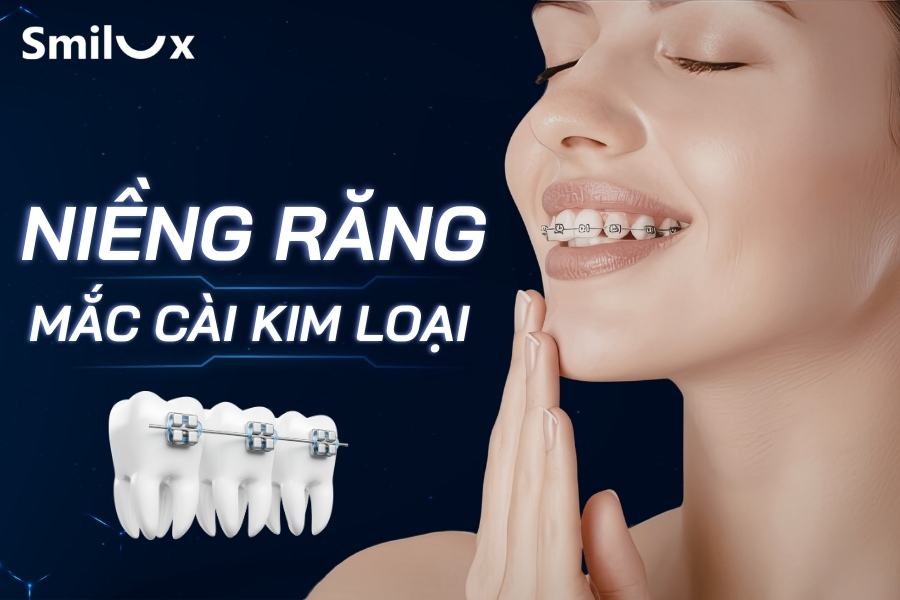 Niềng răng mắc cài kim loại có ưu điểm gì? Chi phí và quy trình thực hiện Niềng răng mắc cài kim loại có ưu điểm gì? Chi phí và quy trình thực hiện