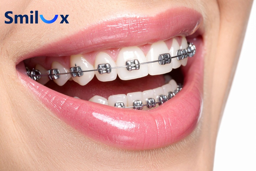 Niềng răng mắc cài kim loại truyền thống Niềng răng mắc cài kim loại truyền thống