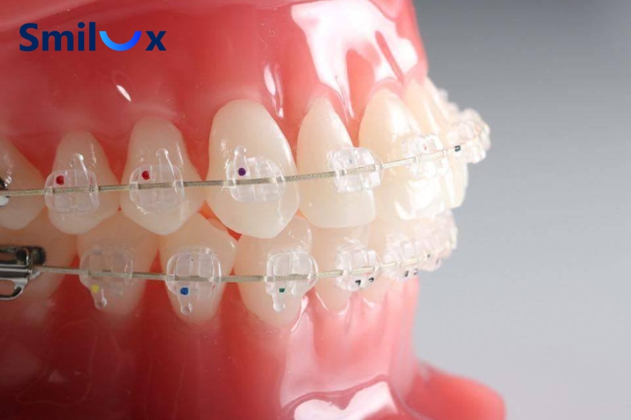Niềng răng mắc cài pha lê là gì? Niềng răng mắc cài pha lê là gì?