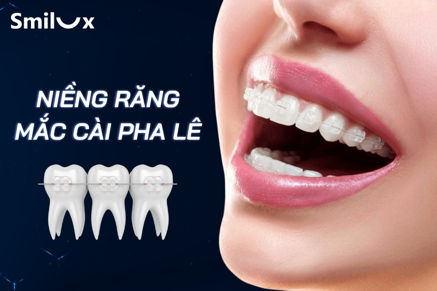 Niềng răng mắc cài pha lê có tốt không? Giá niềng răng pha lê chi tiết Niềng răng mắc cài pha lê có tốt không? Giá niềng răng pha lê chi tiết