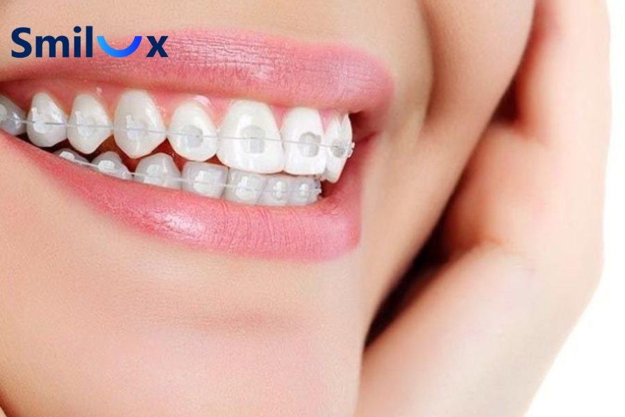 Niềng răng mắc cài sứ có hiệu quả không? CÓ, phương pháp này mang lại hiệu quả chỉnh nha tốt Niềng răng mắc cài sứ có hiệu quả không? CÓ, phương pháp này mang lại hiệu quả chỉnh nha tốt