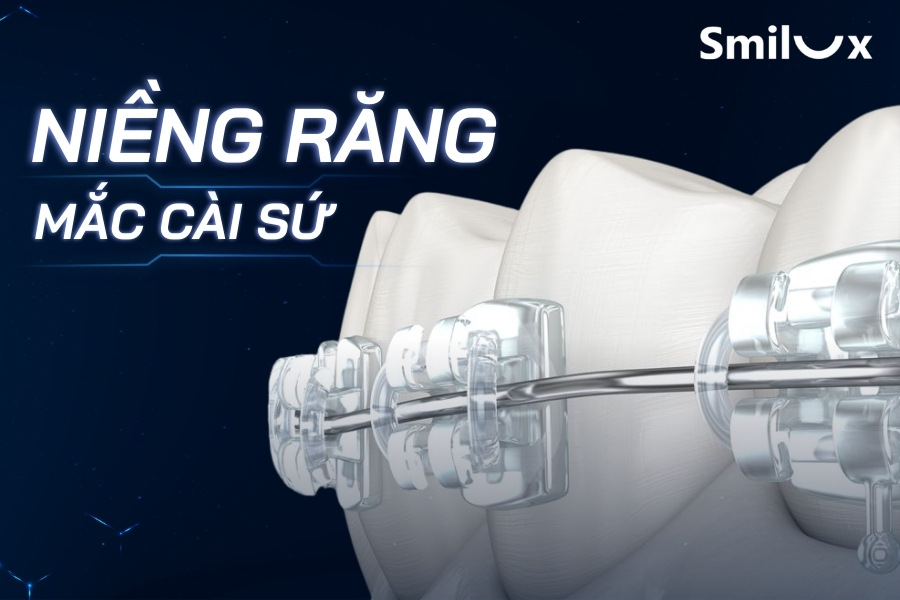 Niềng răng mắc cài sứ có hiệu quả không? Giá bao nhiêu tiền Niềng răng mắc cài sứ có hiệu quả không? Giá bao nhiêu tiền
