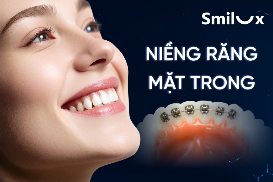 Niềng răng mặt trong là gì? Có hiệu quả không? Chi phí bao nhiêu? Niềng răng mặt trong là gì? Có hiệu quả không? Chi phí bao nhiêu?