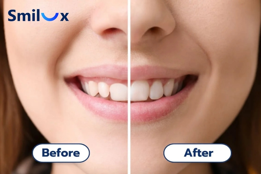 Tăng sinh nướu do niềng răng nên cắt nướu để loại bỏ mô dư và cải thiện thẩm mỹ nụ cười. Tăng sinh nướu do niềng răng nên cắt nướu để loại bỏ mô dư và cải thiện thẩm mỹ nụ cười.