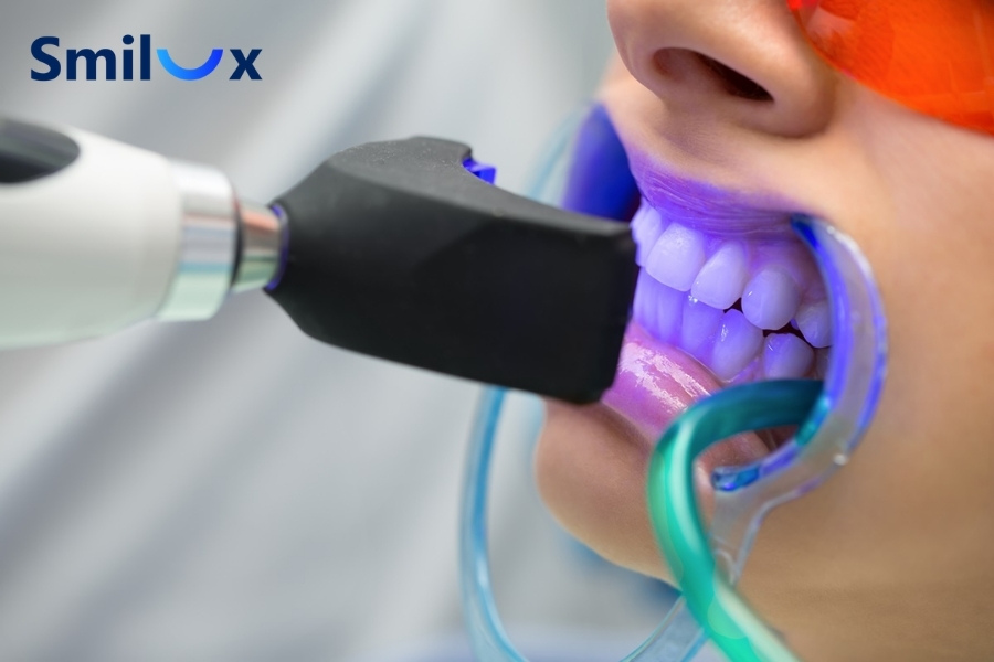 Tẩy trắng răng chuyên nghiệp tại phòng khám Tẩy trắng răng chuyên nghiệp tại phòng khám