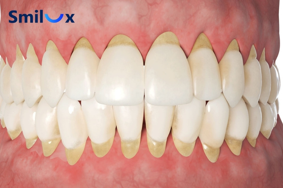 Viêm nha chu nặng có thể phải nhổ răng khi răng lung lay nhiều, tiêu xương nghiêm trọng Viêm nha chu nặng có thể phải nhổ răng khi răng lung lay nhiều, tiêu xương nghiêm trọng