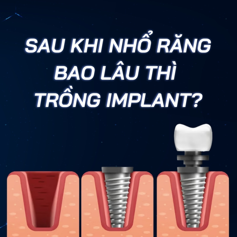 sau khi nhổ răng bao lâu thì trồng implant smilux