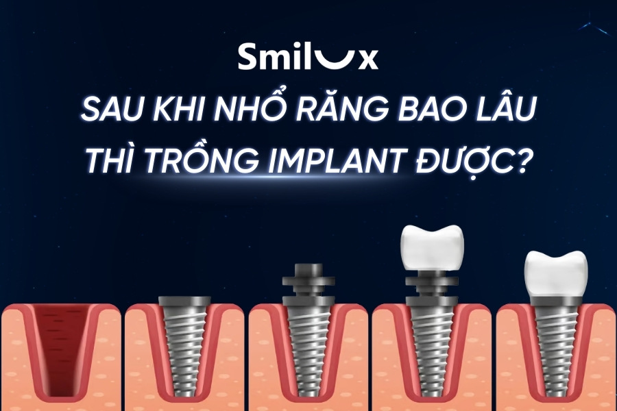Sau khi nhổ răng bao lâu thì trồng Implant được? Sau khi nhổ răng bao lâu thì trồng Implant được?