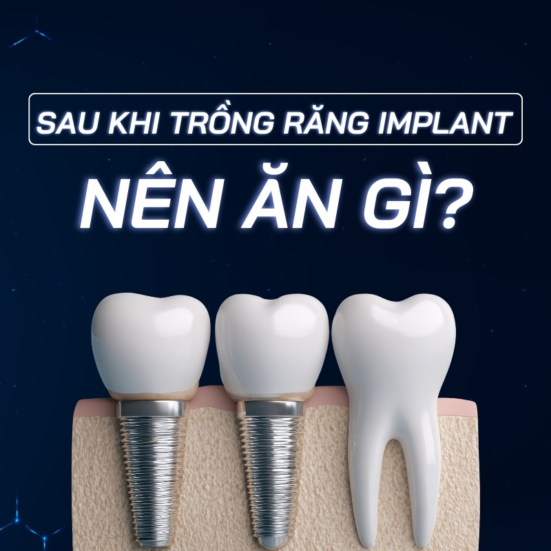 sau khi trồng răng implant nên ăn gì tại smilux