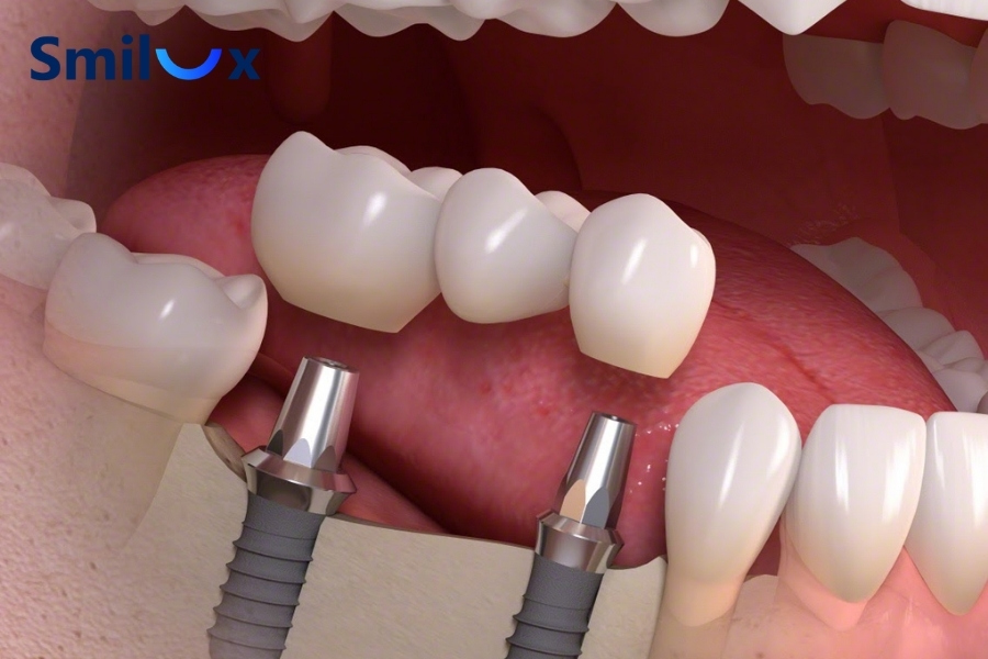 Cấy Implant bao lâu thì gắn răng? Tùy vào số lượng trụ Implant Cấy Implant bao lâu thì gắn răng? Tùy vào số lượng trụ Implant
