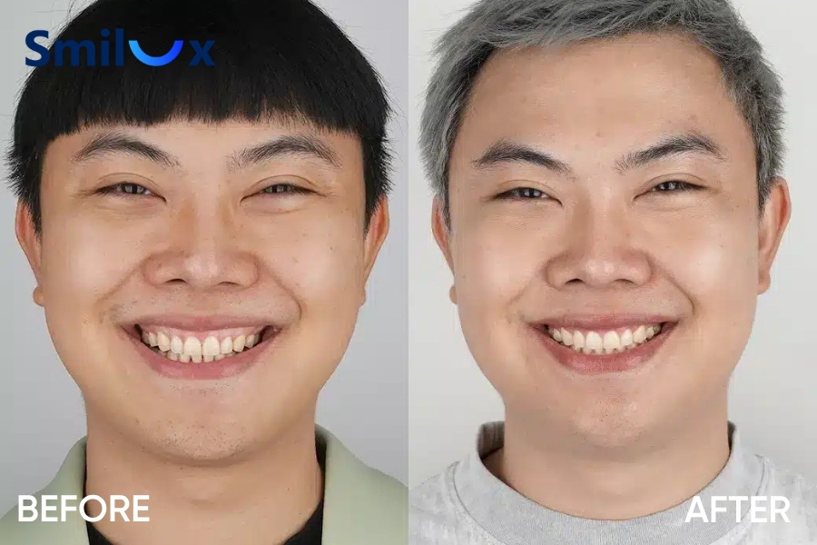 Lợi thừa, lợi trùm răng khôn nên cắt nướu tạo hình để loại bỏ mô dư, hạn chế viêm và dễ vệ sinh hơn. Lợi thừa, lợi trùm răng khôn nên cắt nướu tạo hình để loại bỏ mô dư, hạn chế viêm và dễ vệ sinh hơn.