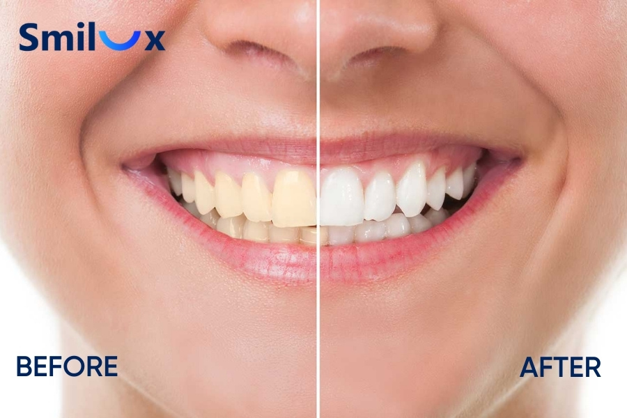 Tẩy trắng răng sử dụng hoạt chất chuyên dụng để loại bỏ các sắc tố gây xỉn màu Tẩy trắng răng sử dụng hoạt chất chuyên dụng để loại bỏ các sắc tố gây xỉn màu