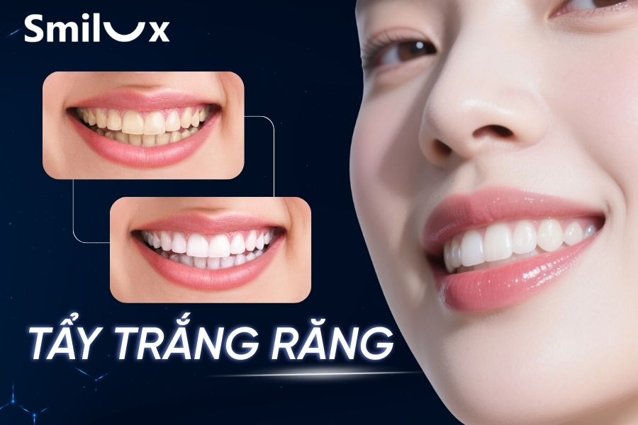 Tẩy trắng răng hết bao nhiêu tiền? Có nên tẩy trắng răng không? Tẩy trắng răng hết bao nhiêu tiền? Có nên tẩy trắng răng không?