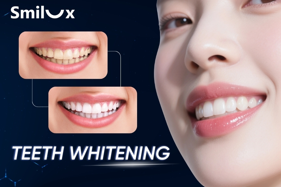 How much does teeth whitening cost? Is teeth whitening recommended? How much does teeth whitening cost? Is teeth whitening recommended?