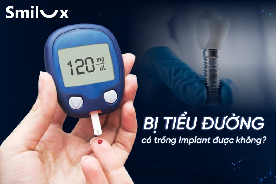 Cô/chú bị tiểu đường có trồng răng Implant được không? Cô/chú bị tiểu đường có trồng răng Implant được không?