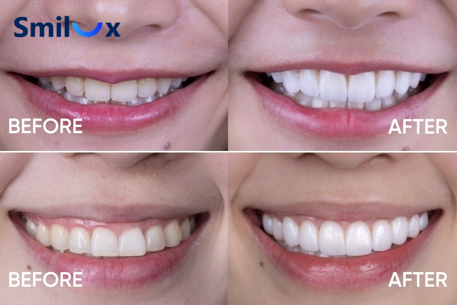 Răng còn khỏe thì khi bọc răng sứ không cần lấy tủy Răng còn khỏe thì khi bọc răng sứ không cần lấy tủy