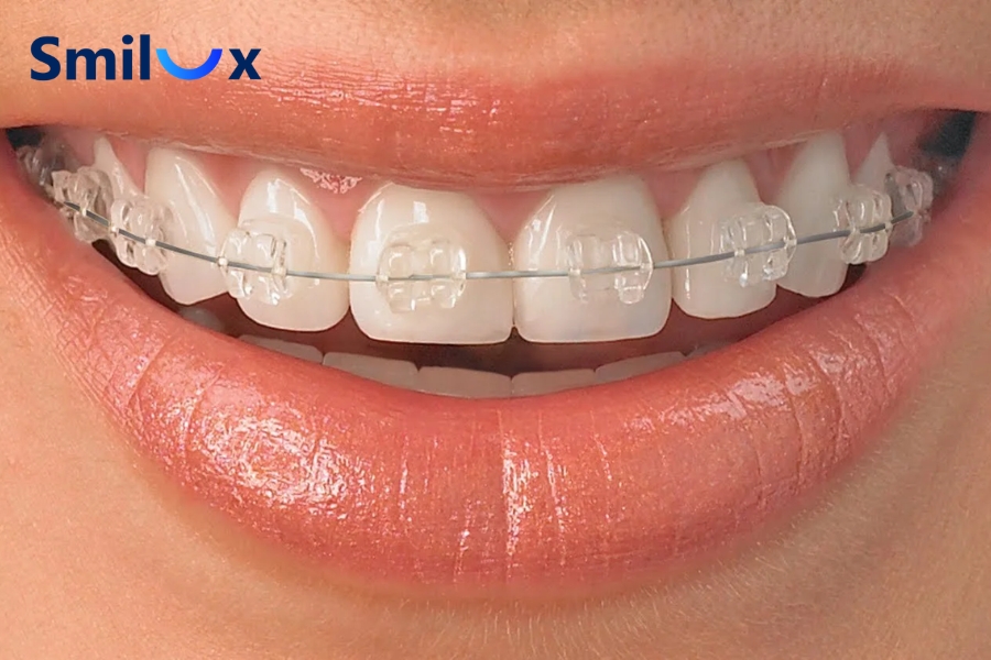 Mắc cài pha lê có độ trong suốt cao nên khi gắn lên răng sẽ khó nhận thấy ở khoảng cách thông thường Mắc cài pha lê có độ trong suốt cao nên khi gắn lên răng sẽ khó nhận thấy ở khoảng cách thông thường