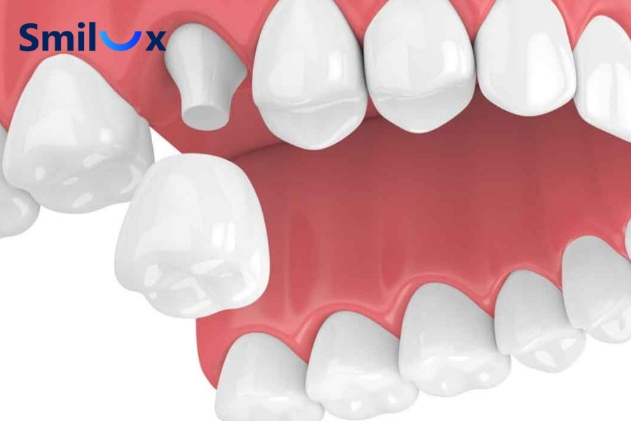 Bọc răng sứ có bị rơi ra không? Câu trả lời là CÓ Bọc răng sứ có bị rơi ra không? Câu trả lời là CÓ