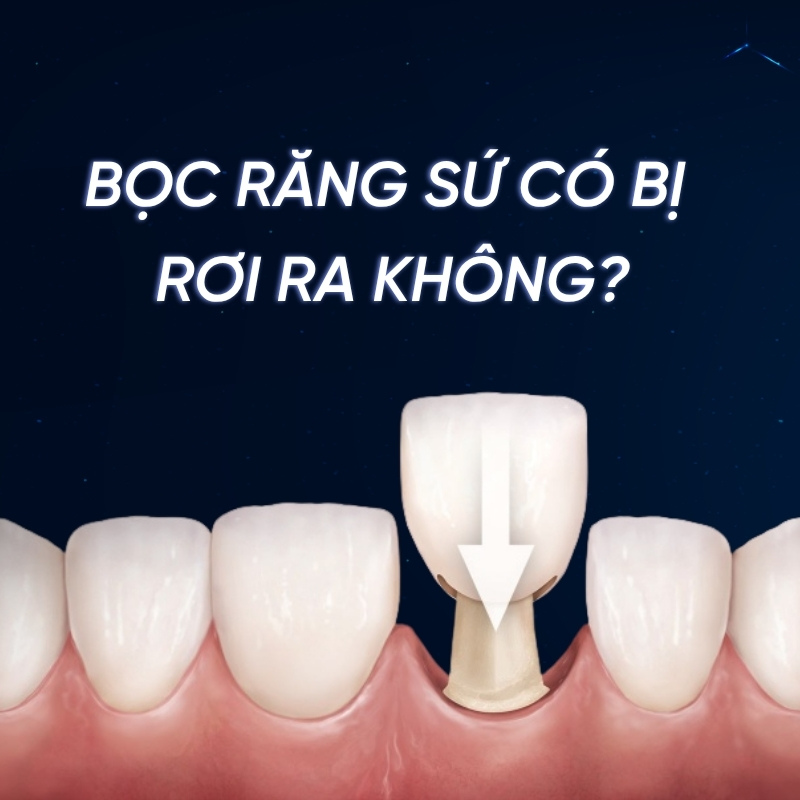 Bọc răng sứ có bị rơi ra không? Cách gắn lại răng sứ bị rớt