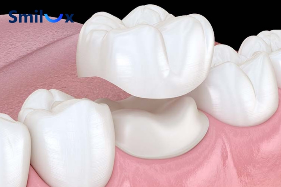 Làm răng sứ có đau không? Câu trả lời là KHÔNG Làm răng sứ có đau không? Câu trả lời là KHÔNG