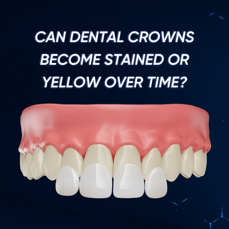 Can Dental Crowns Become Stained or Yellow Over Time smilux dental